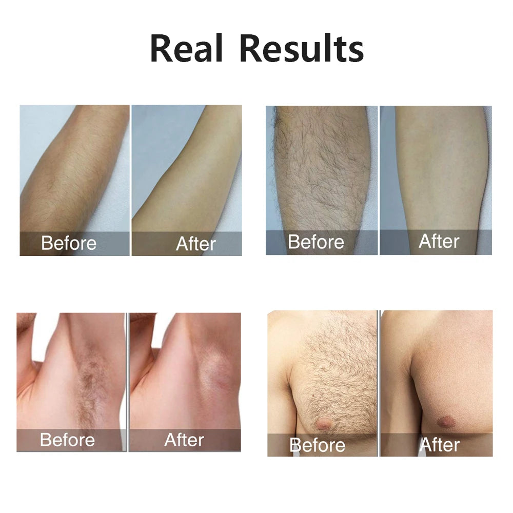 Inovia™ Portable IPL Laser Epilator MedikStat